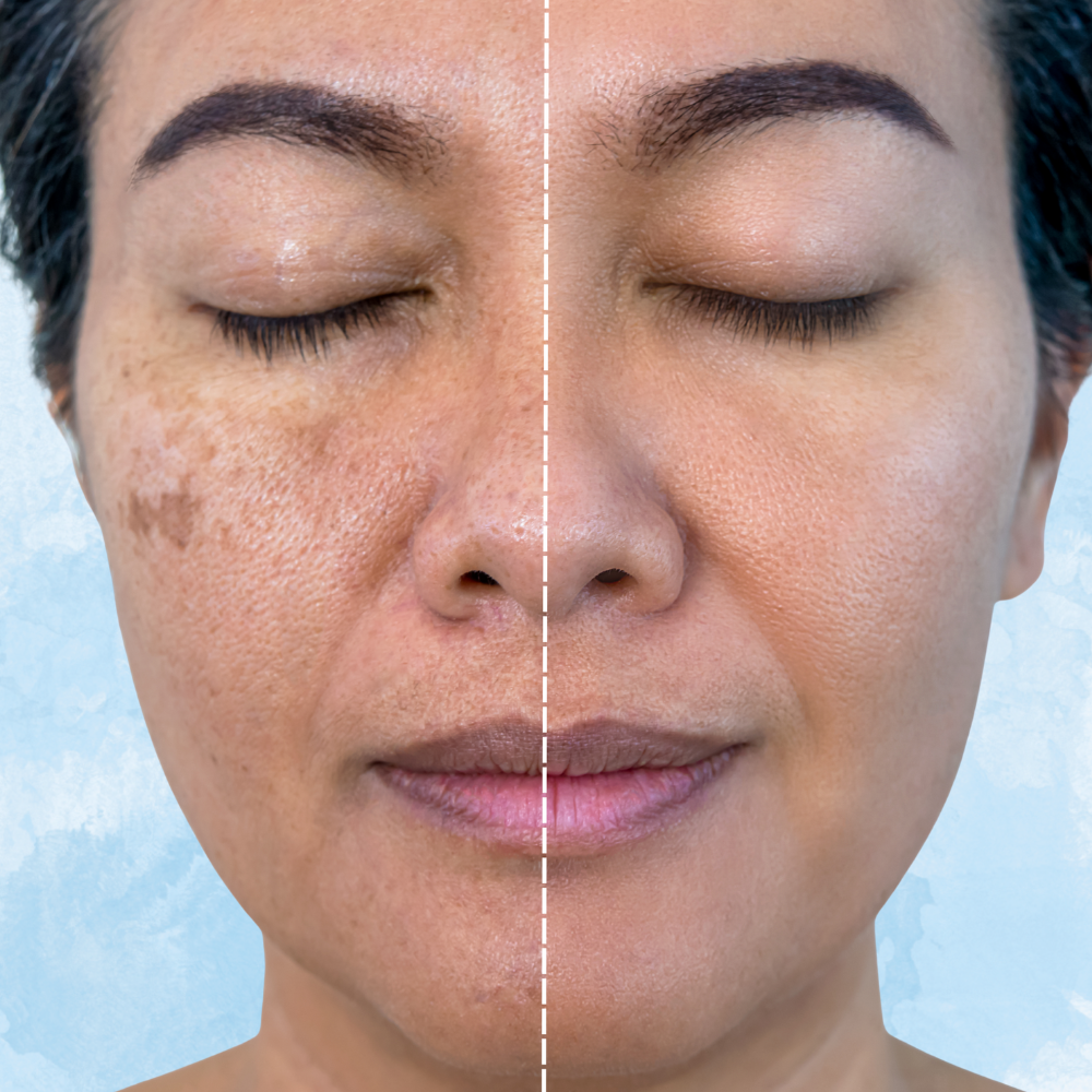 Laser Skin Treatments