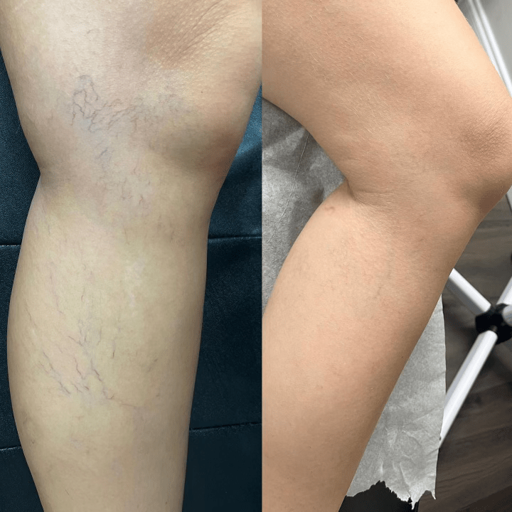 Spider-vein-removal-2-min