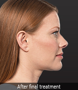 kybella-after
