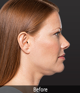 kybella-before
