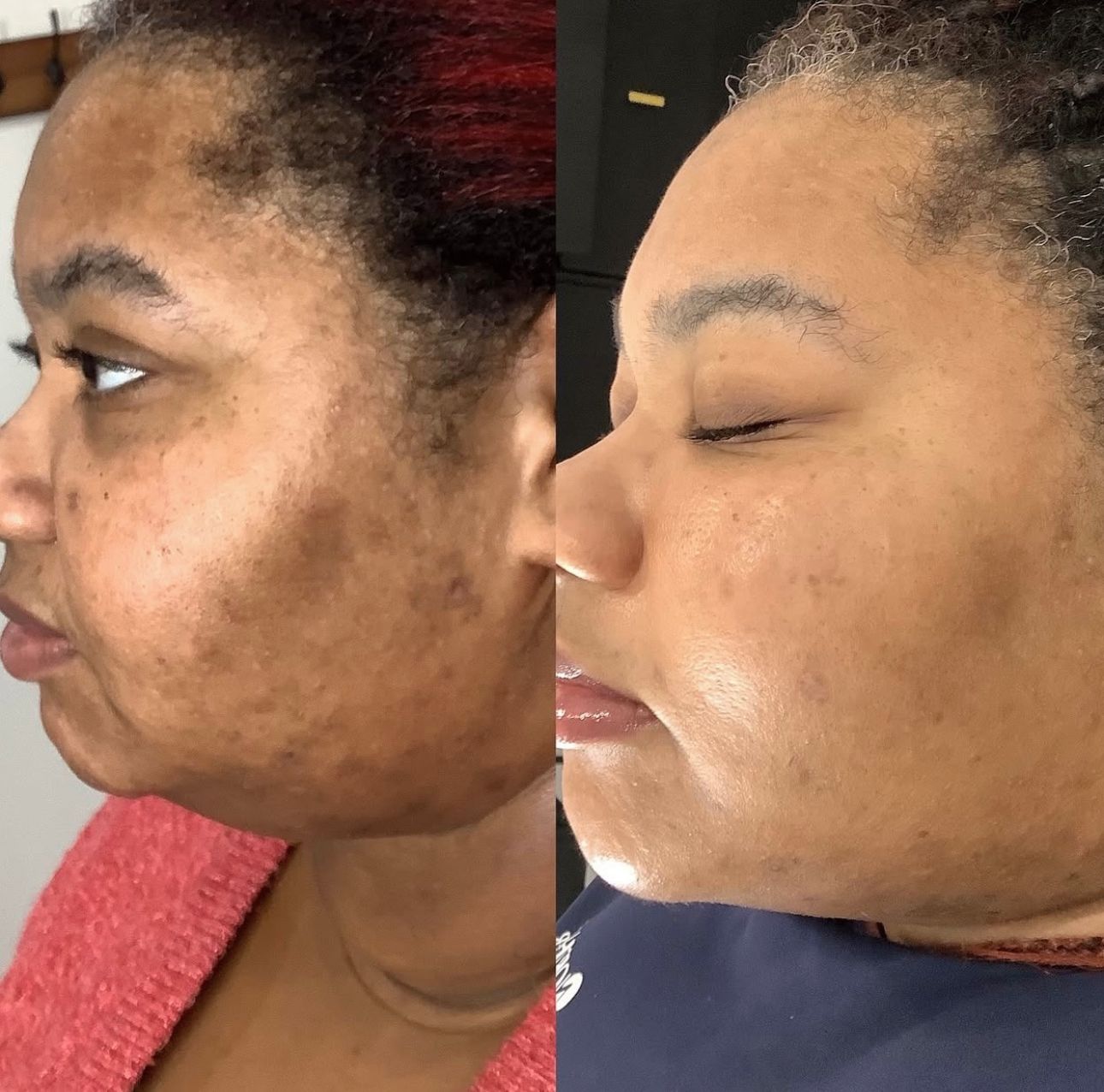 Facial balancing transformation with strategic filler placement and Botox to create a more symmetrical, youthful, and balanced appearance.
