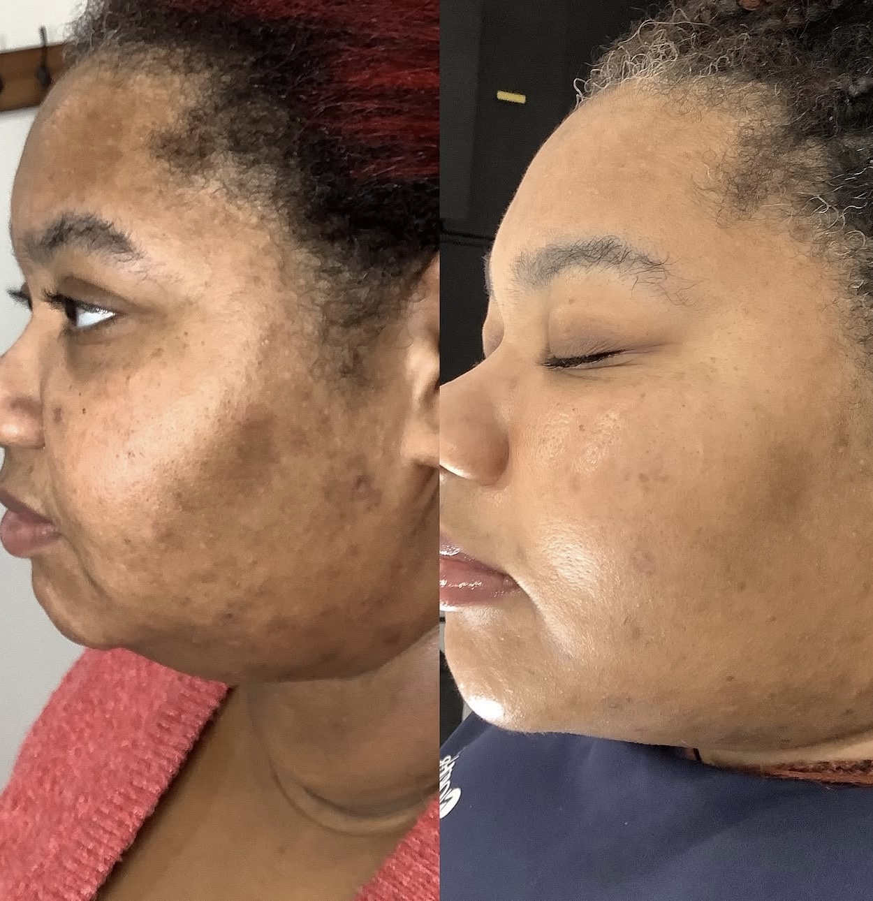 Before and after Aerolase Neo Elite treatment in Coral Springs.