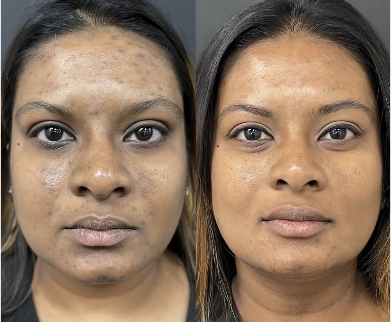 Before and after facial balancing treatment using Botox, cheek filler, lip filler, smile line filler, and chin filler to enhance facial symmetry and harmony.