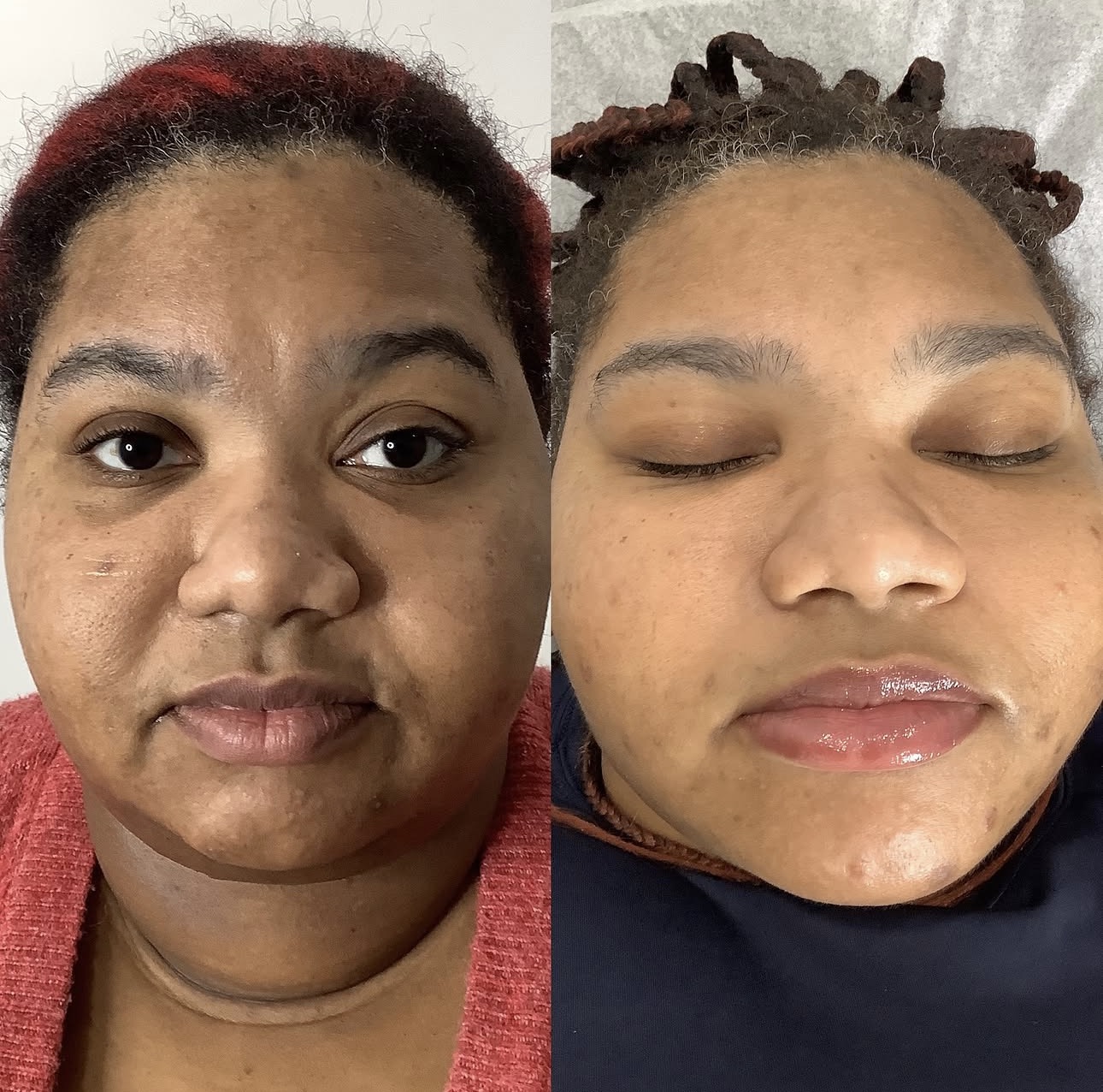 Facial balancing transformation with strategic filler placement and Botox to create a more symmetrical, youthful, and balanced appearance.