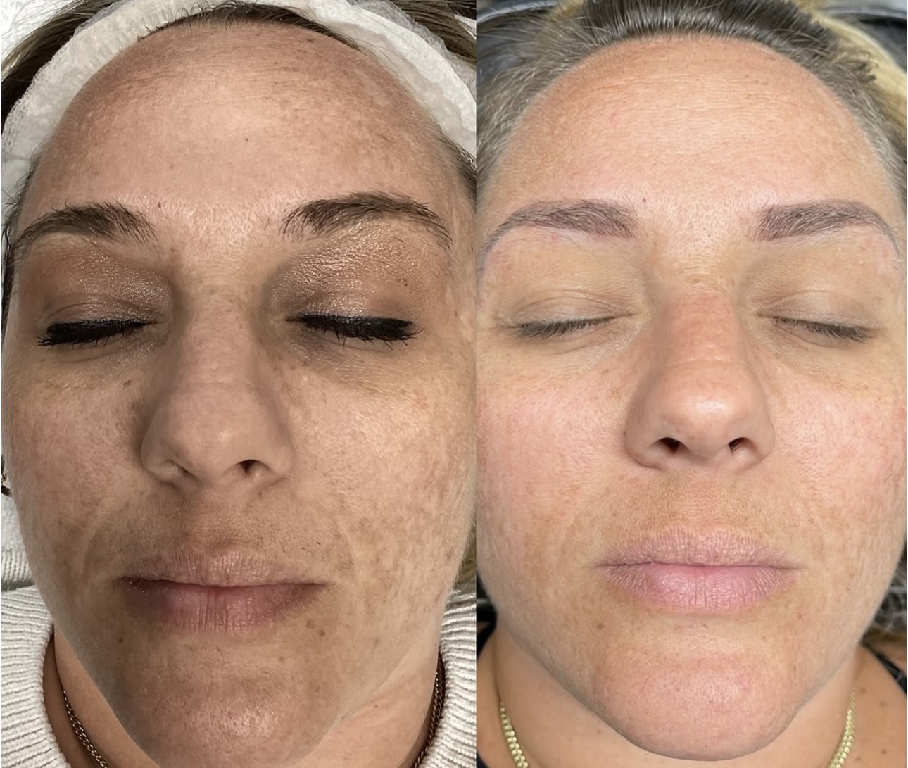 Facial balancing transformation with strategic filler placement and Botox to create a more symmetrical, youthful, and balanced appearance.