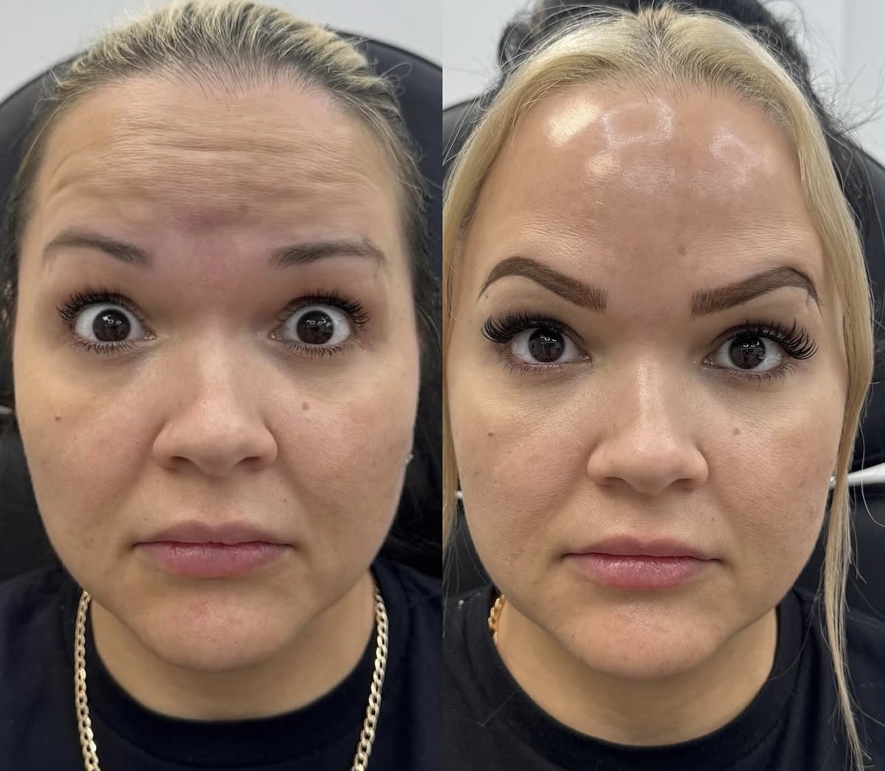 Screenshot Medical professional wearing gloves administering brow lift wrinkle relaxer treatment