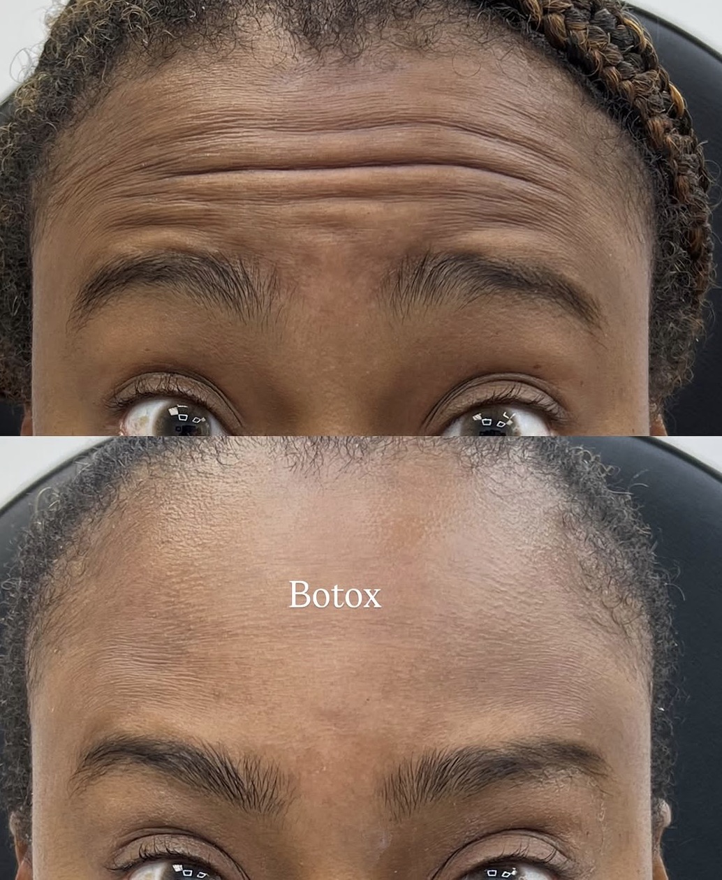 Screenshot Injection of wrinkle relaxers around the eye area to treat crow's feet at a medical spa