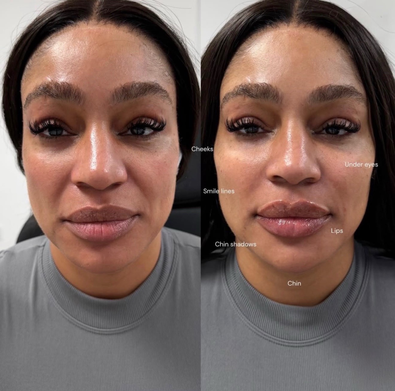 Facial Balancing 4 Before and after facial balancing treatment using Botox, cheek filler, lip filler, smile line filler, and chin filler to enhance facial symmetry and harmony.