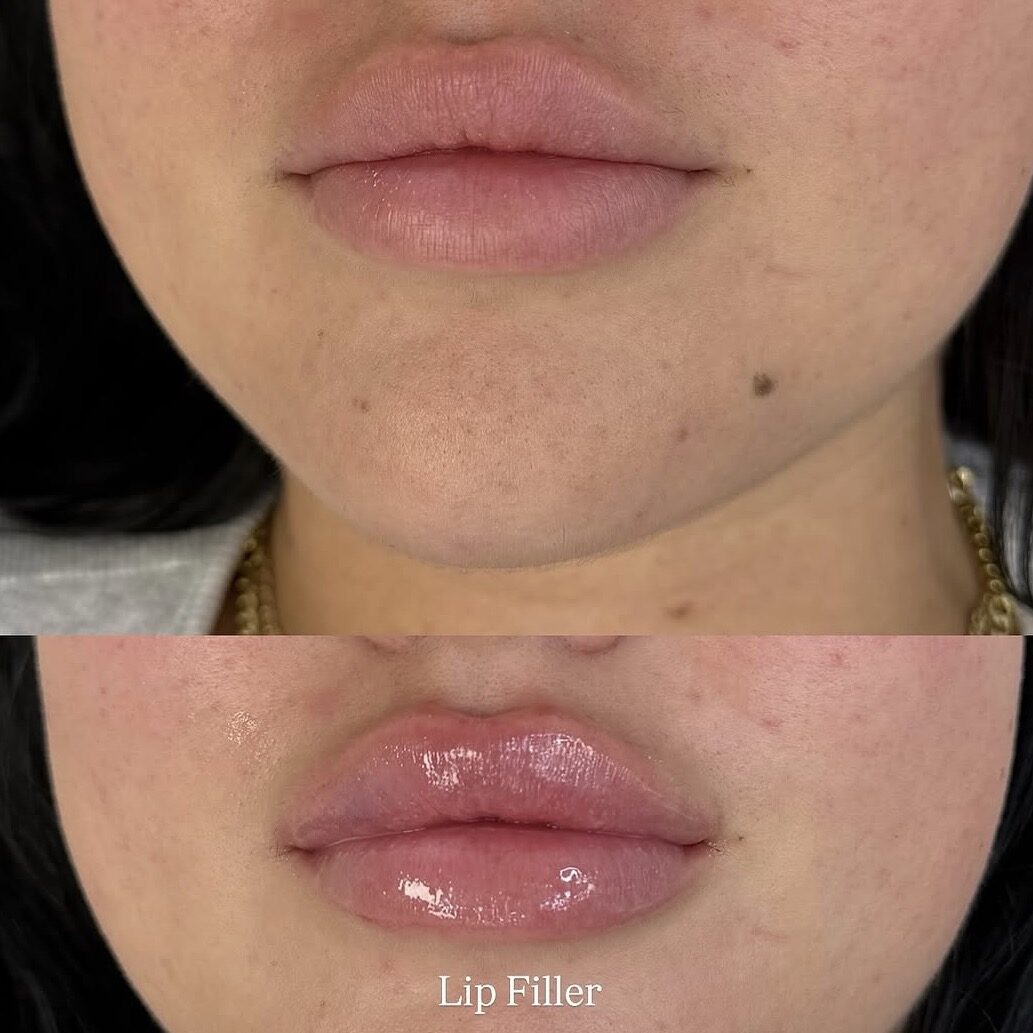 Before and after facial balancing procedure demonstrating enhanced chin definition, fuller lips, smoother smile lines, and improved facial contours.