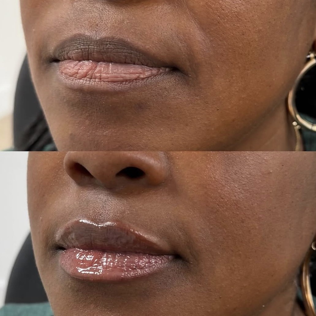 Facial balancing transformation with strategic filler placement and Botox to create a more symmetrical, youthful, and balanced appearance.