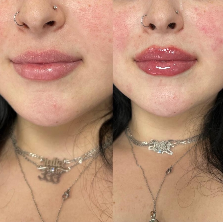 Patient receiving dermal filler injection at Beauty Health Med Spa in Coral Springs